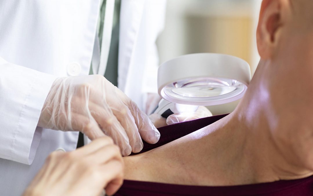 Radijacijski Dermatitis – Simptomi i kako ih ublažiti